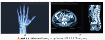BÀI 5: TIA X. CHỤP ẢNH X – QUANG VÀ CHỤP ẢNH CẮT LỚP (CT)